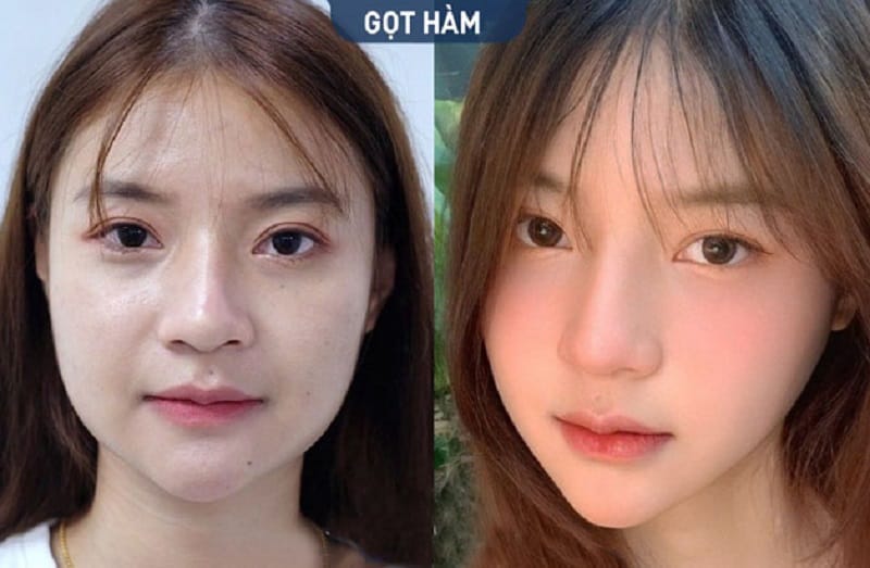 Ứng dụng công nghệ hiện đại giúp mang đến chiếc cằm thon gọn, cân đối