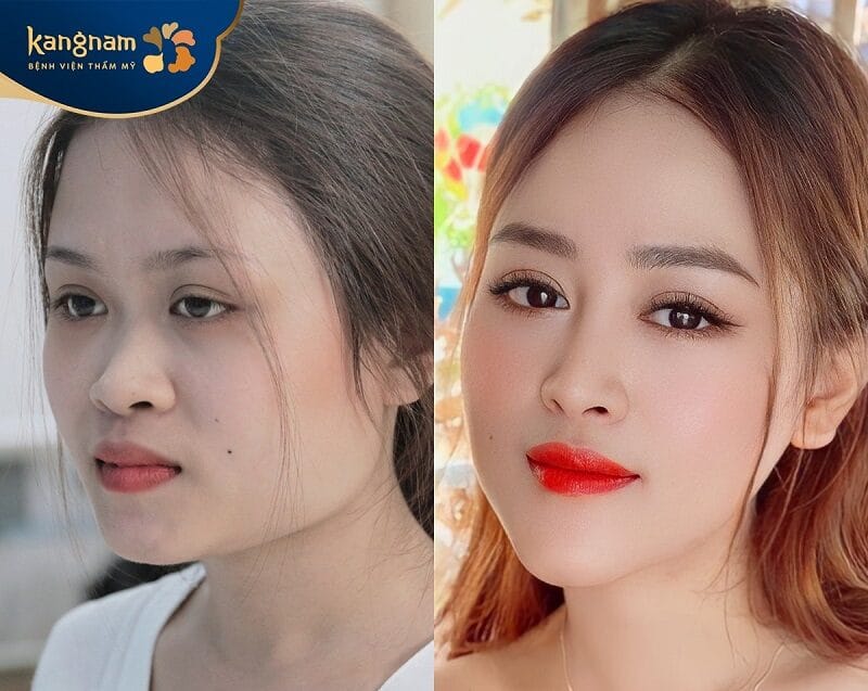 Khách hàng sở hữu dáng cằm vline cân đối với gương mặt