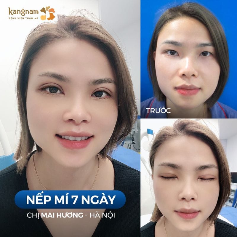 Vùng mí mắt mềm mại, không còn cảm giác cứng hay đau