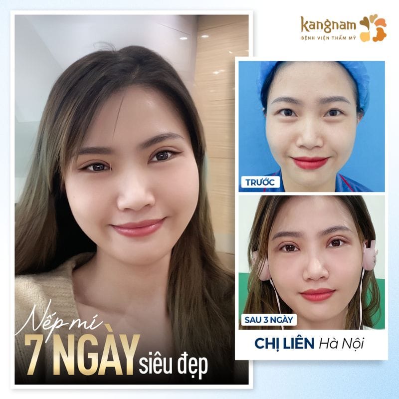 Nếp mí đều và cân đối sau một tuần hồi phục