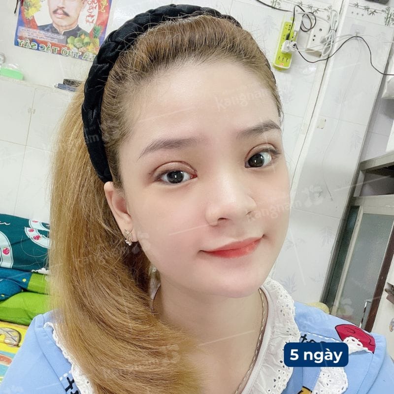 mí mắt đã bớt sưng, rõ nếp hơn