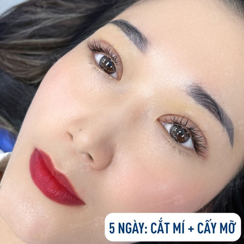 Mí mắt bắt đầu vào form tự nhiên