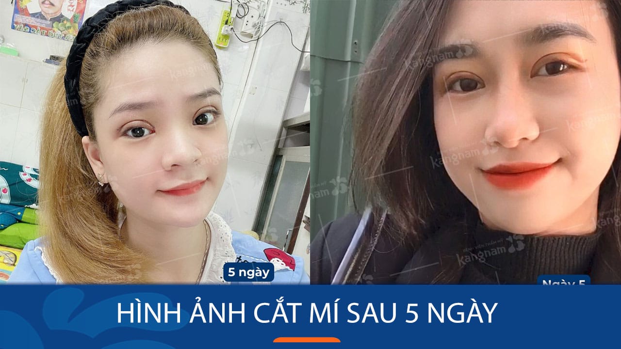 Hình ảnh cắt mí sau 5 ngày: Kết quả thực tế bất ngờ