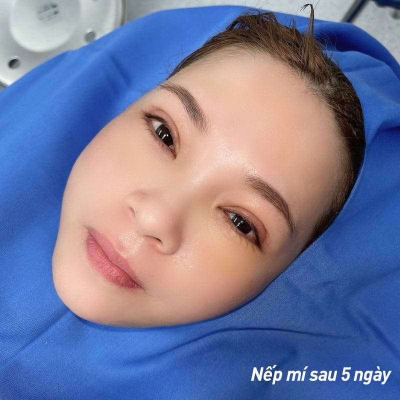Kết quả sau 5 ngày: rõ nếp mí, không biến chứng