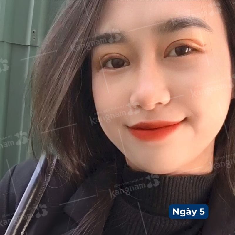 Mí đều và sắc nét, tình trạng bầm tím gần như biến mất