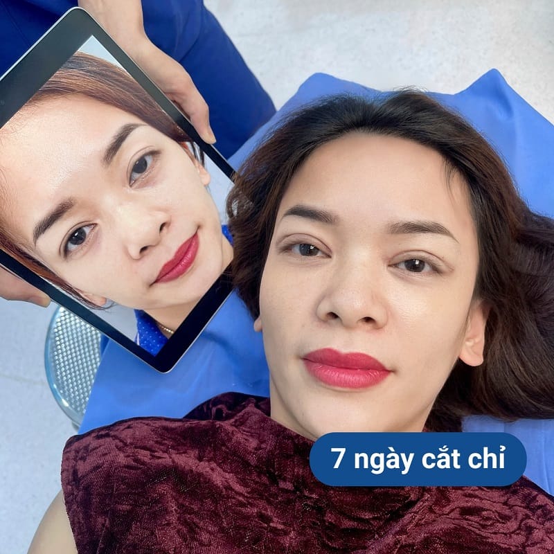 Khách hàng có thể cắt chỉ sau khoảng 7 ngày