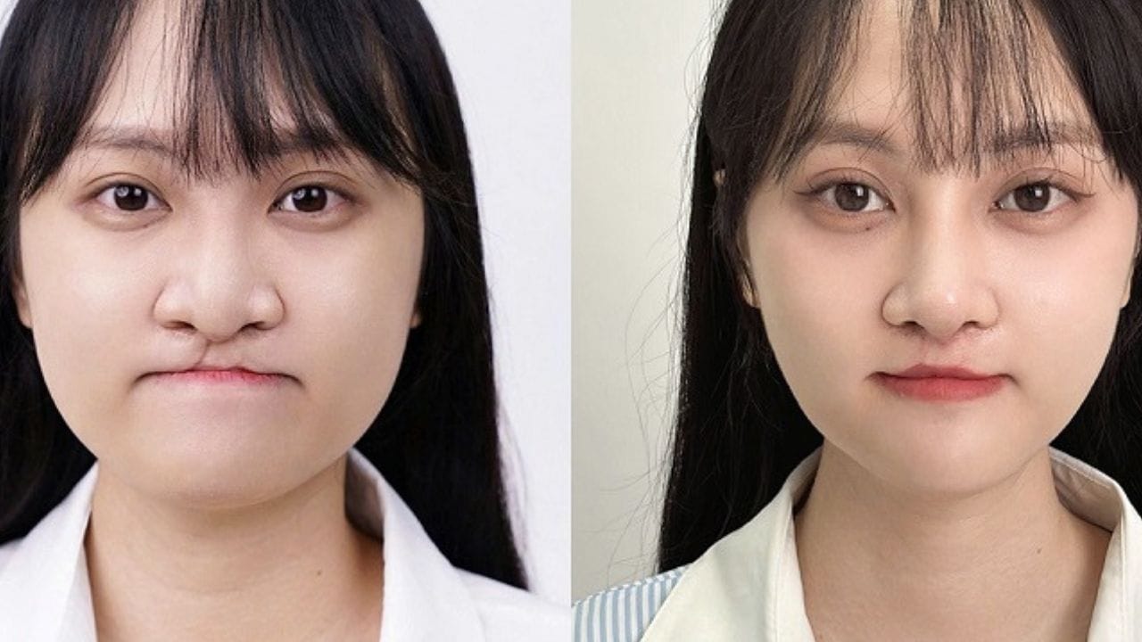 Hình ảnh sau khi phẫu thuật hở hàm ếch