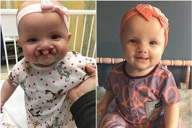 Trẻ nhỏ sau khi phẫu thuật hở hàm ếch