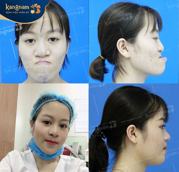 Thời gian phục hồi hoàn toàn kéo dài sau khoảng 3 - 6 tháng