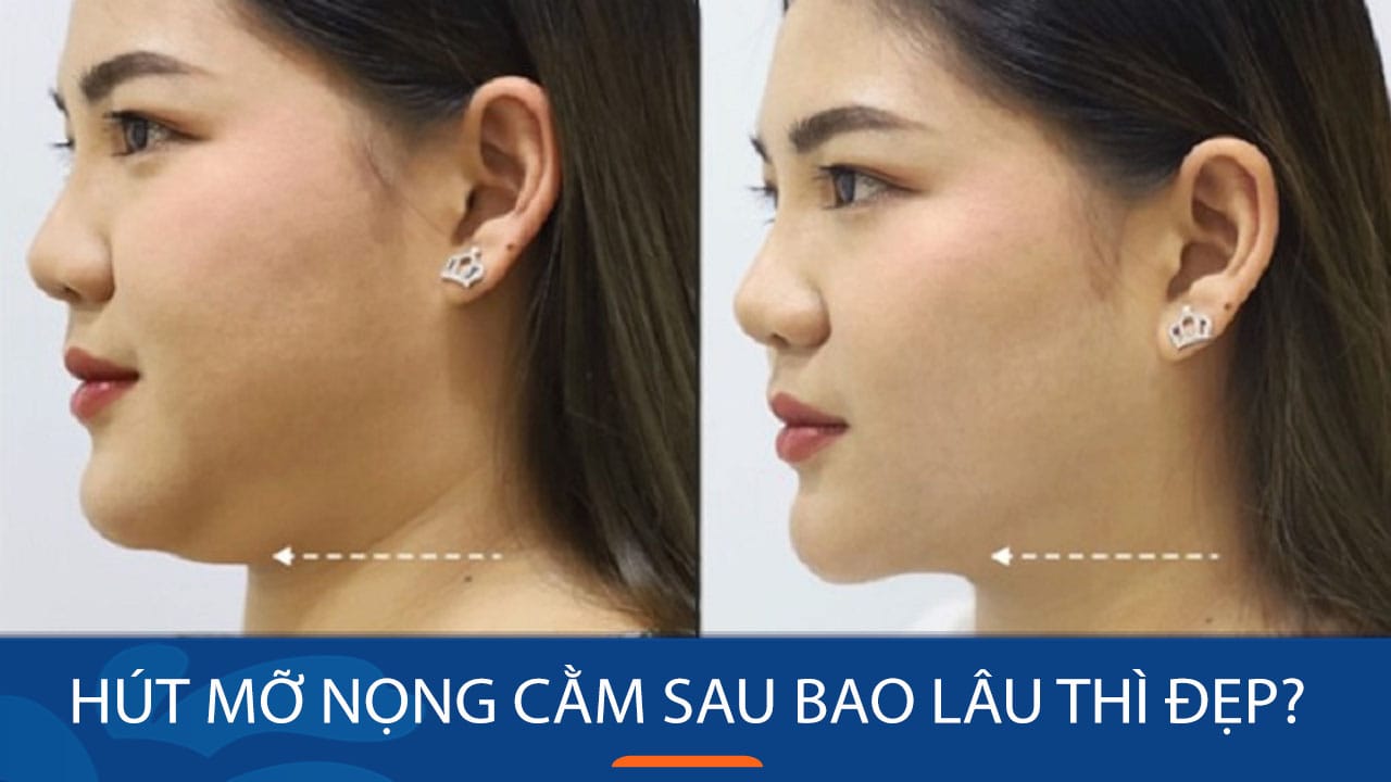Hút mỡ nọng cằm sau bao lâu thì đẹp? cần lưu ý điều gì