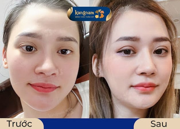 Khách hàng trước và sau khi cấy mỡ hốc mắt + cắt mí tại cơ sở uy tín