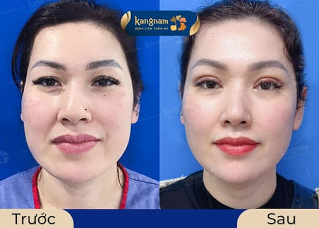 Khách hàng cấy mỡ mắt + cắt mí tại Kangnam