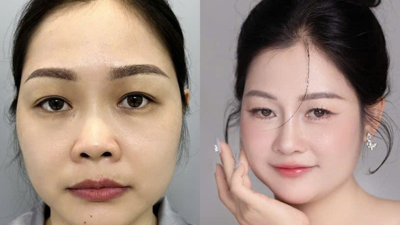 Nâng mũi cấu trúc bao lâu thì gom lại? Cần lưu ý điều gì