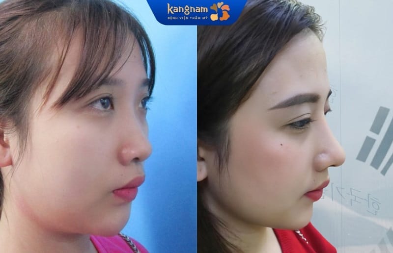 Mũi hết sưng tấy, vào dáng đẹp tự nhiên