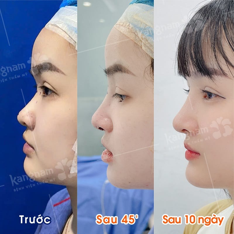 Thời gian mũi gom lại sau nâng mũi cấu trúc tùy thuộc vào nhiều yếu tố
