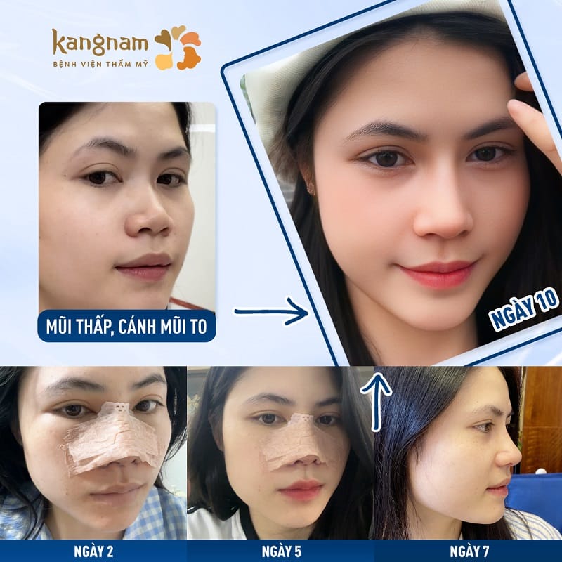 Tuân thủ theo hướng dẫn chăm sóc của bác sĩ, lựa chọn cơ sở thẩm mỹ nâng mũi uy tín