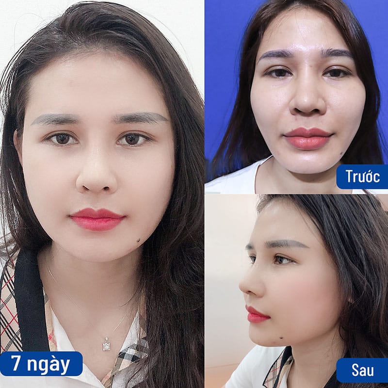 Hình ảnh khách hàng sau nâng mũi, sự thay đổi ấn tượng