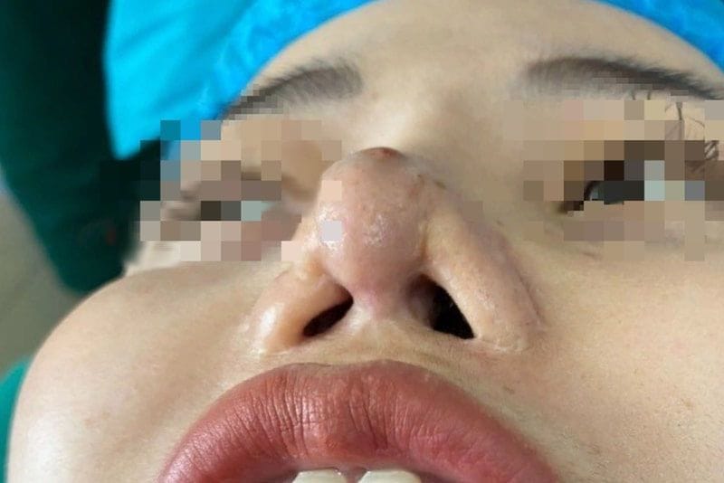 Nâng mũi giá rẻ tiềm ẩn rủi ro biến chứng