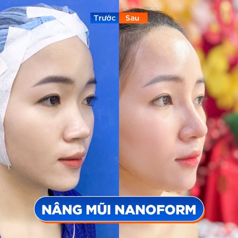 Sự thay đổi rõ rệt sau nâng mũi, đường nét thanh tú hơn
