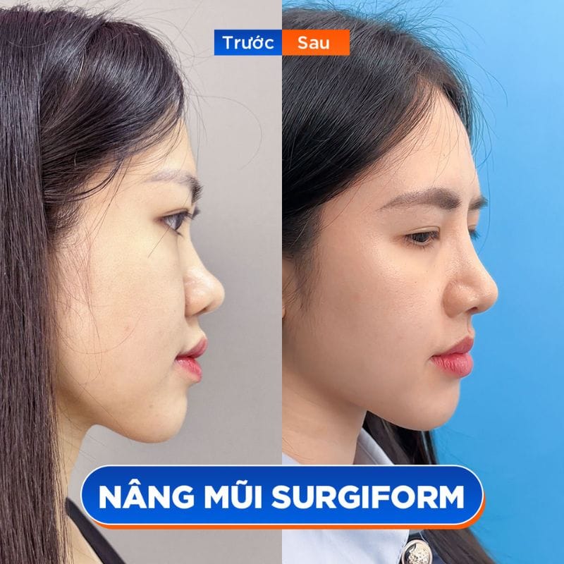 Kết quả nâng mũi tự nhiên, hài hòa với khuôn mặt