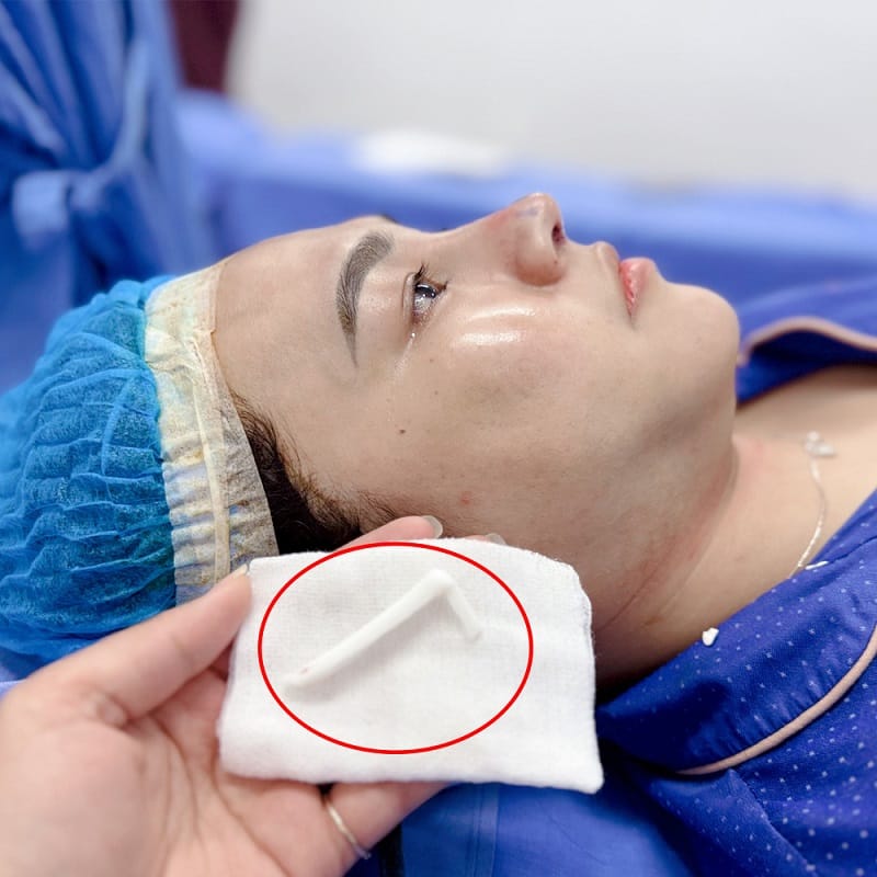 Thăm khám và được tư vấn cụ thể trước khi nâng mũi