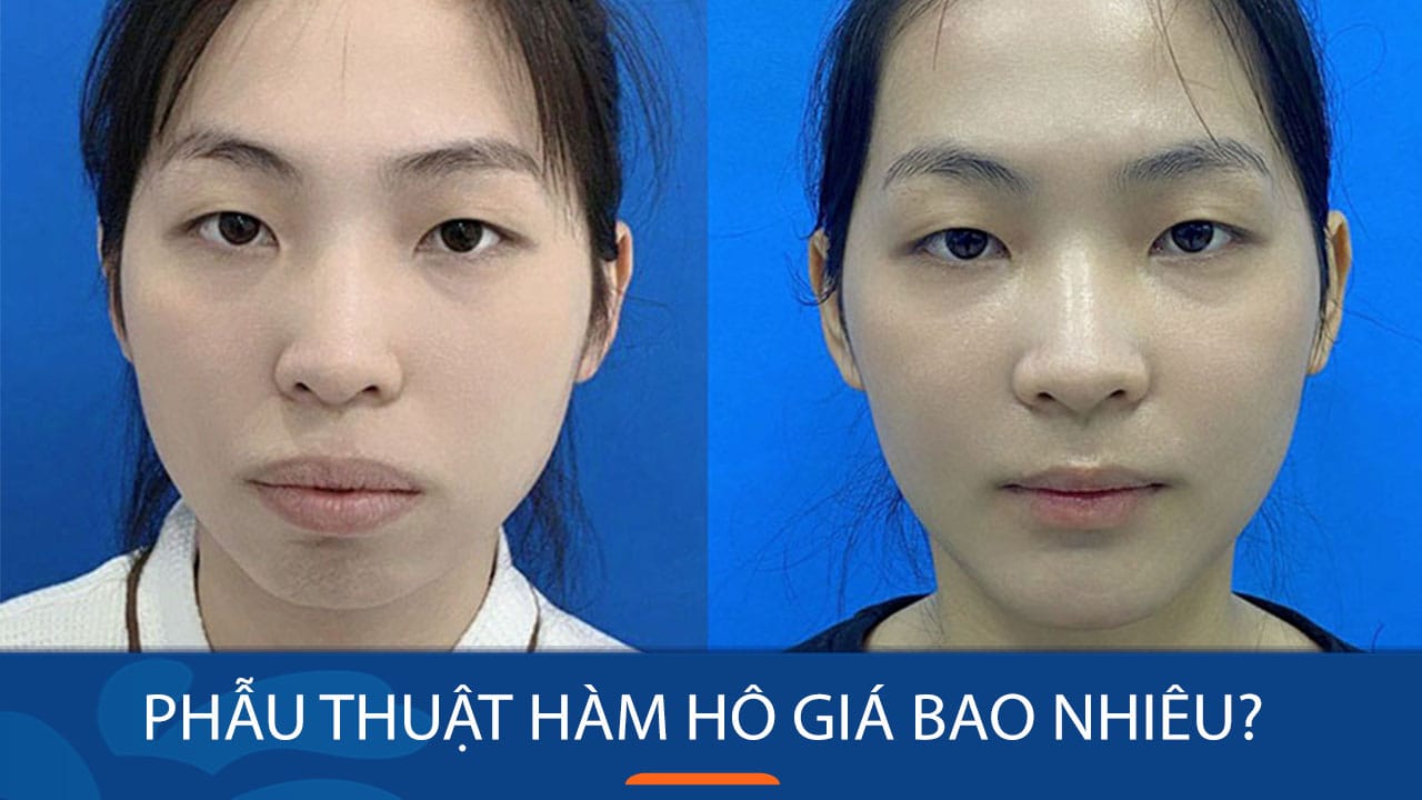 Phẫu thuật hàm hô giá bao nhiêu? các yếu tố quan trọng