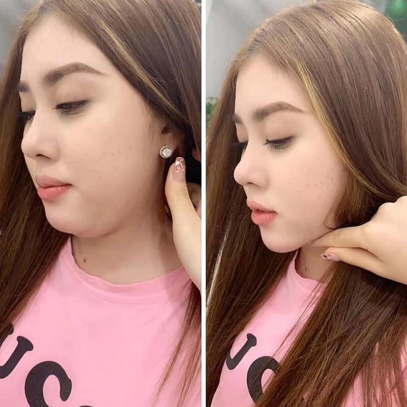 Tùy vào tình trạng mỡ thừa, bác sĩ sẽ tư vấn liều lượng tiêm tan mỡ nọng cằm khác nhau