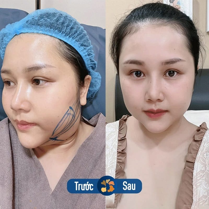 Hút mỡ nọng cằm mang lại hiệu quả nhanh, lâu dài