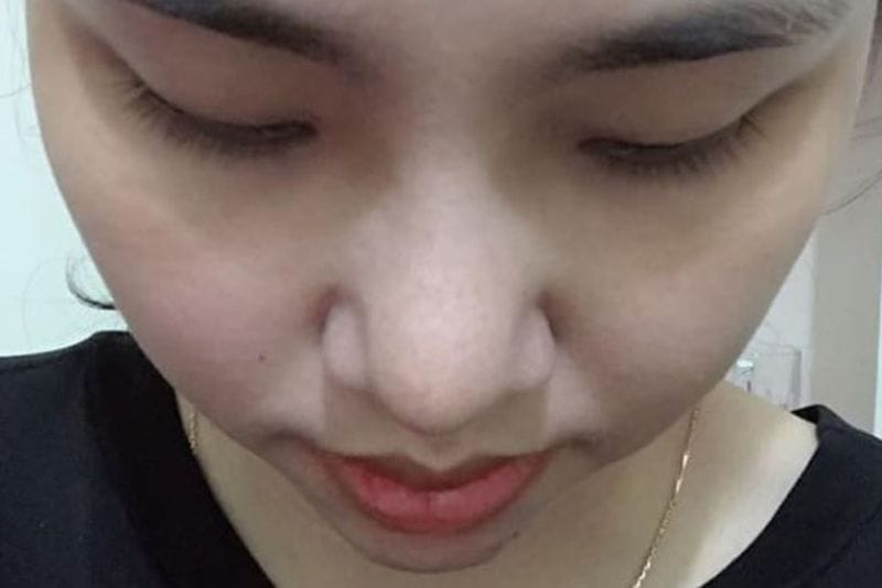 Thời gian hồi phục sau tháo sụn mũi khoảng 1-2 tuần