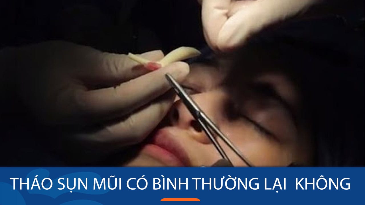Tháo sụn mũi có trở lại bình thường không? Giải đáp từ chuyên gia
