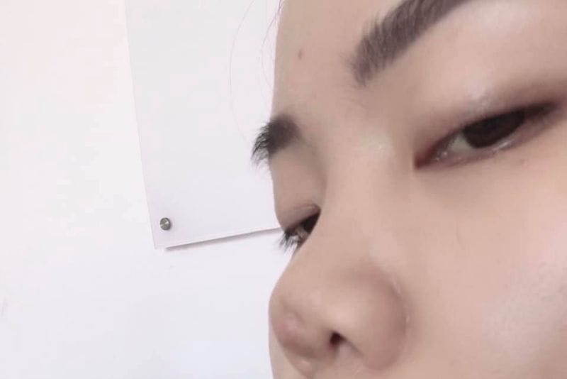 Đầu mũi bị lõm sau khi tháo sụn