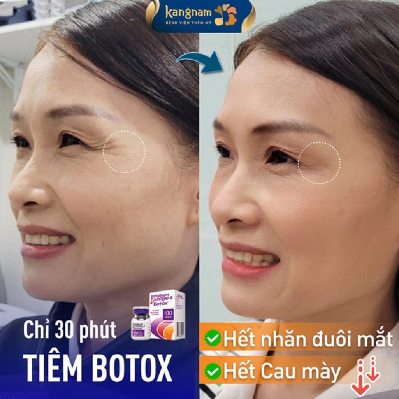 Tiêm xóa nhăn mắt đảm bảo an toàn tại cơ sở thẩm mỹ uy tín