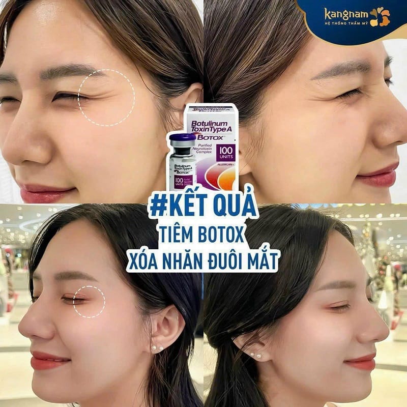 Sử dụng botox chất lượng cao, giúp mang lại kết quả tối ưu