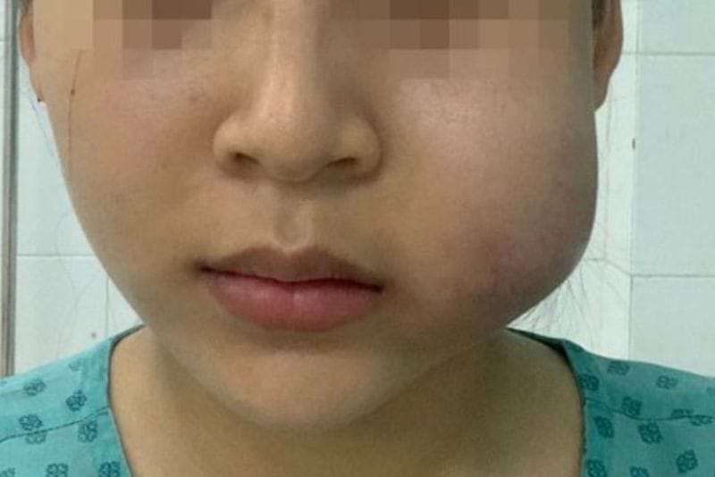 Hình ảnh minh họa sưng sau tiêm filler