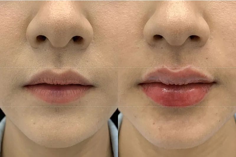 Giá tiêm filler phụ thuộc vào loại filler