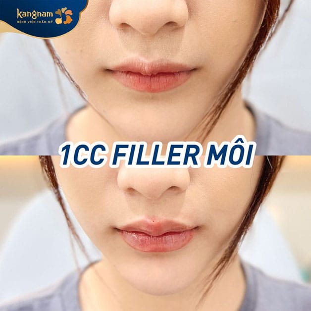 1CC filler tương đương 1ml