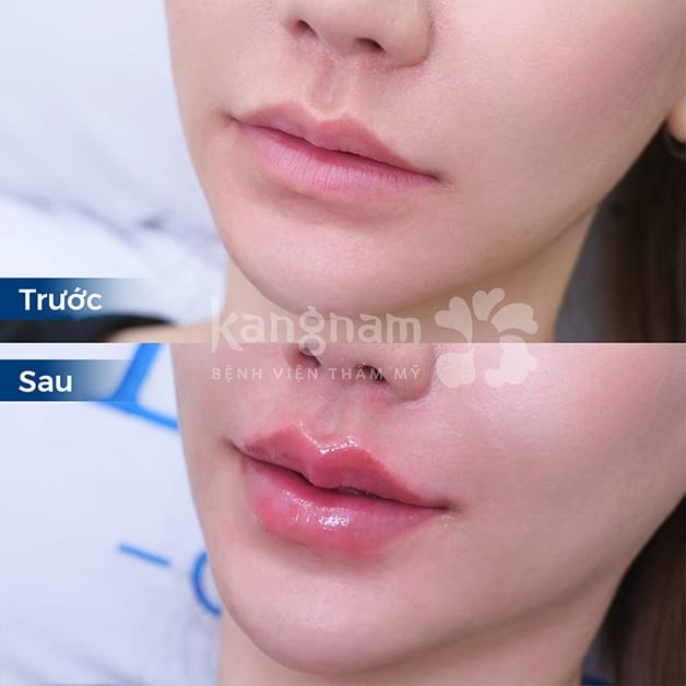 Khách hàng tiêm filler môi sở hữu đôi môi căng mọng