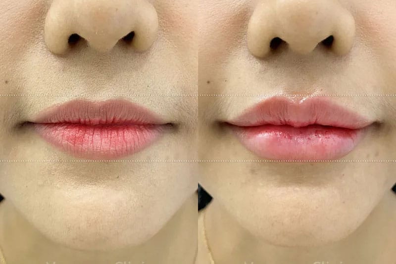 Tiêm filler tạo môi tim quyến rũ