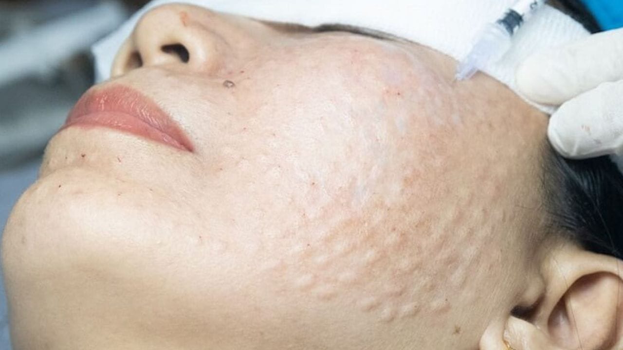 Tiêm meso bao lâu có tác dụng? cần lưu ý điều gì