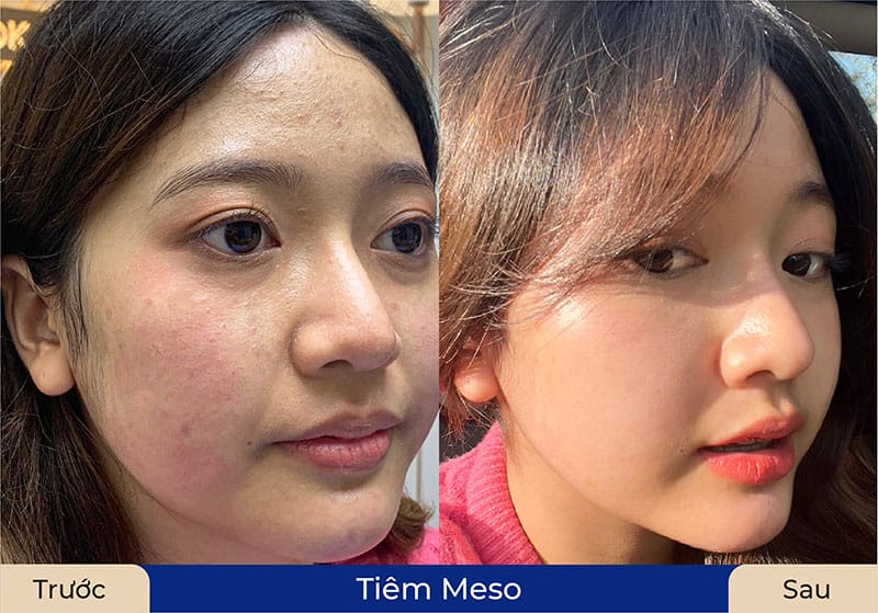 Nên thực hiện tiêm meso theo liệu trình để đạt kết quả tốt nhất
