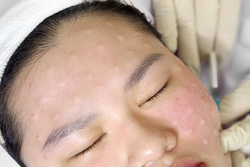 Quá trình tiêm nhanh gọn, không đau, không sẹo