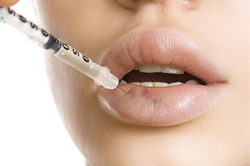 Tiêm tan filler sẽ có tác dụng trong 24–48 giờ sau tiêm