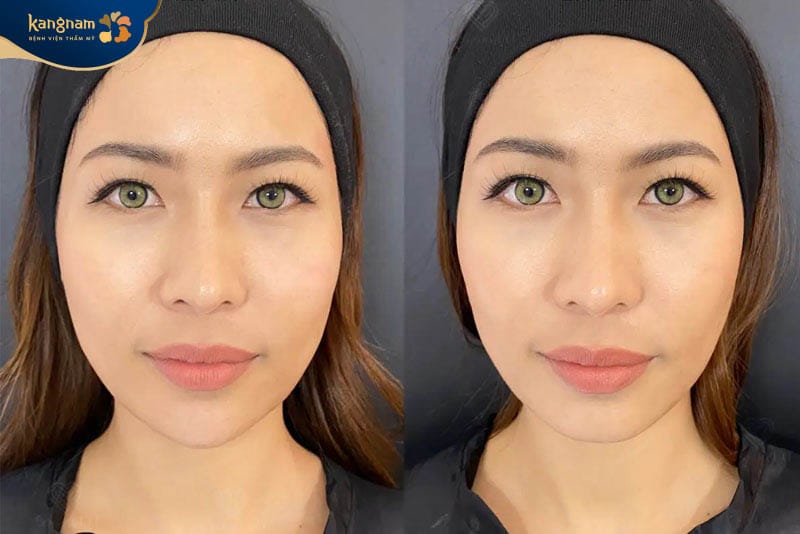 Khi tiêm tan filler đúng cách sẽ không gây biến chứng, rủi ro xảy ra