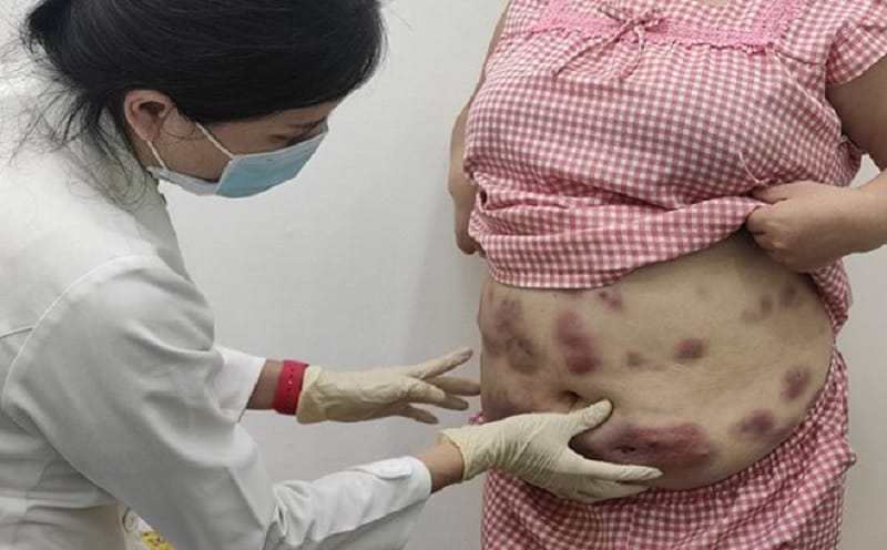 Tiêm tan mỡ giá rẻ có thể gây nhiều biến chứng