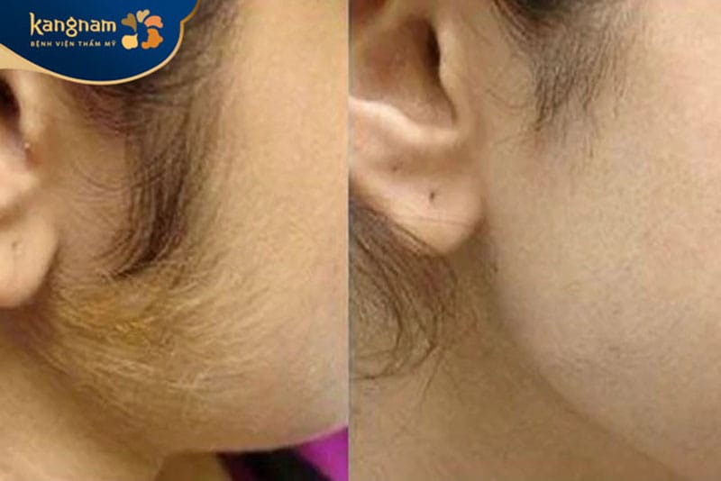 Tránh thực hiện triệt lông chi phí thấp