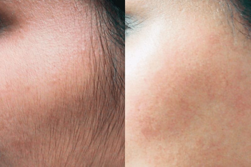 Nên thực hiện liệu trình triệt lông để mang lại hiệu quả cao