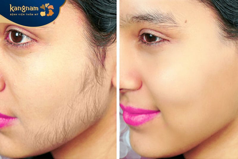 Triệt lông mặt có chi phí rất đa dạng