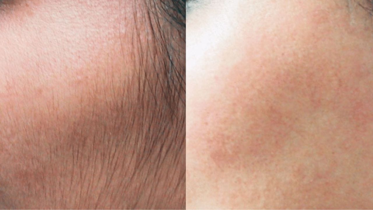 Triệt lông mặt giá bao nhiêu 1 lần? liệu trình có dài không