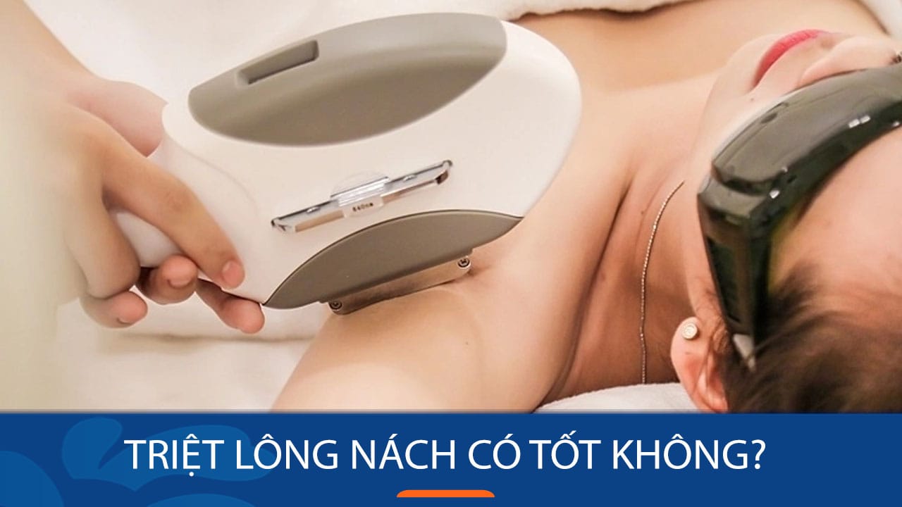 Triệt lông nách có tốt không? Giải đáp từ bác sĩ Kangnam