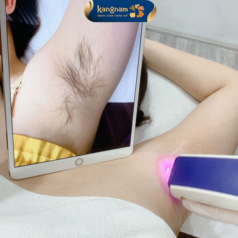 Diode Laser tác động vào nang lông mà không ảnh hưởng đến các tuyến mồ hôi nằm sâu bên dưới da